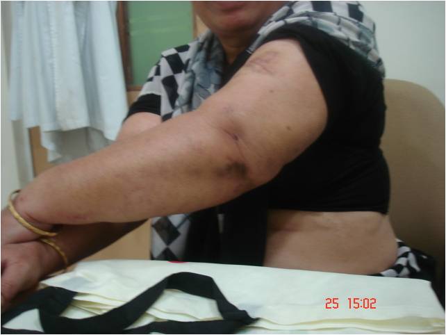 Arm Lift Surgery After Image