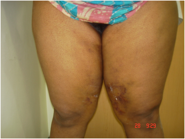 Thigh Fat removal After