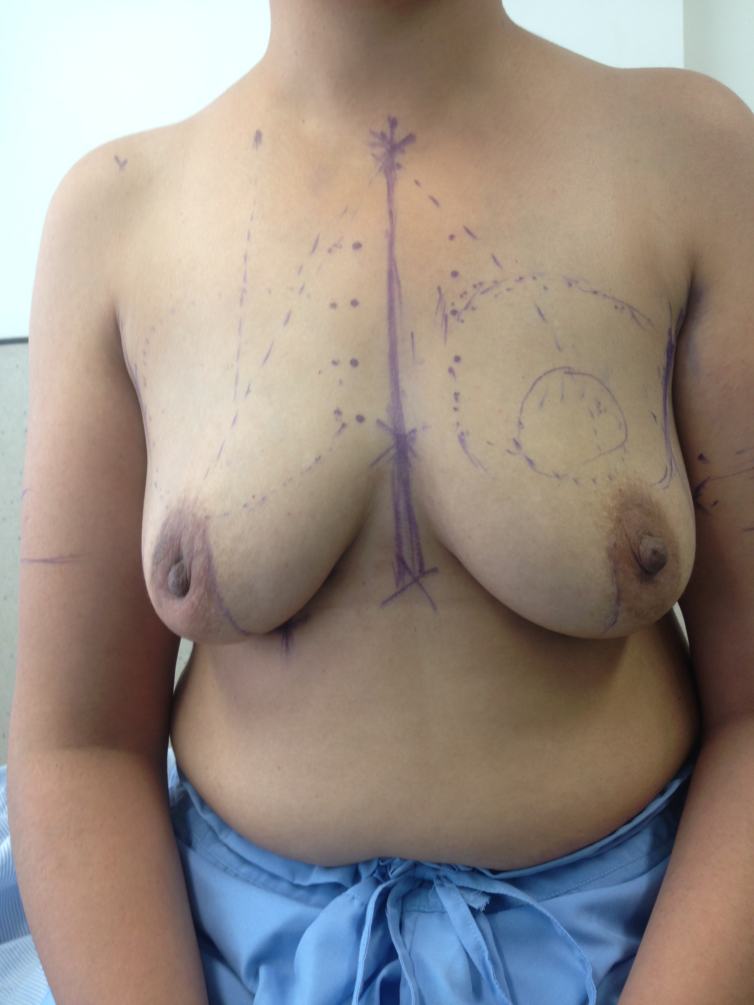 Before Breast Lift Surgery Image