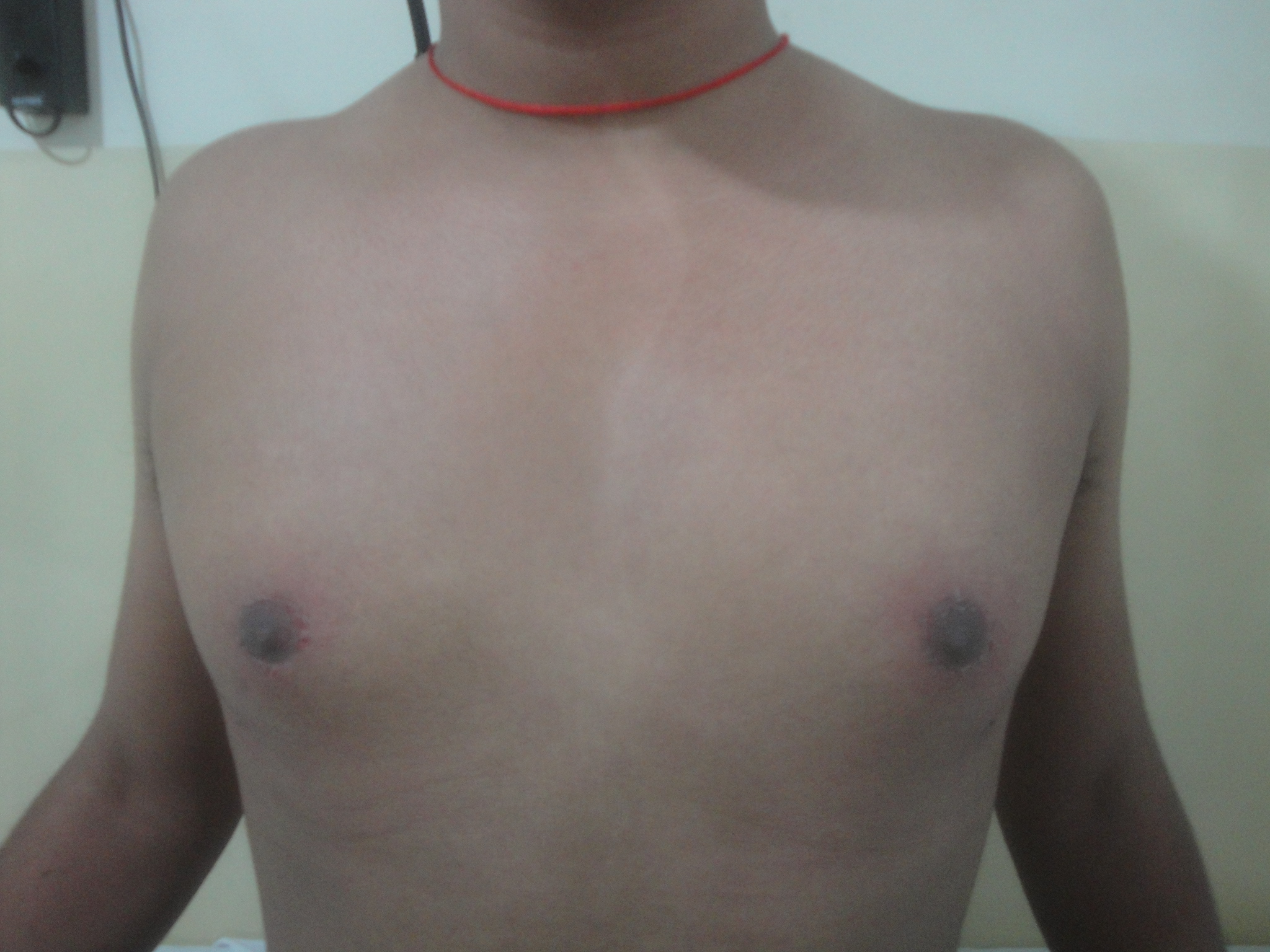 Male Breast Reduction After Surgery