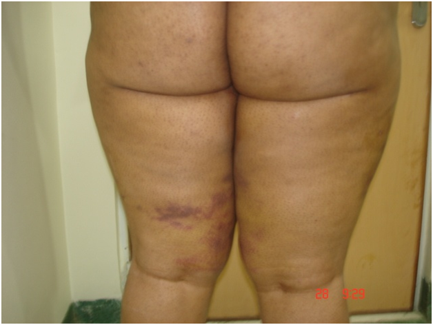 After Thigh Fat Removal