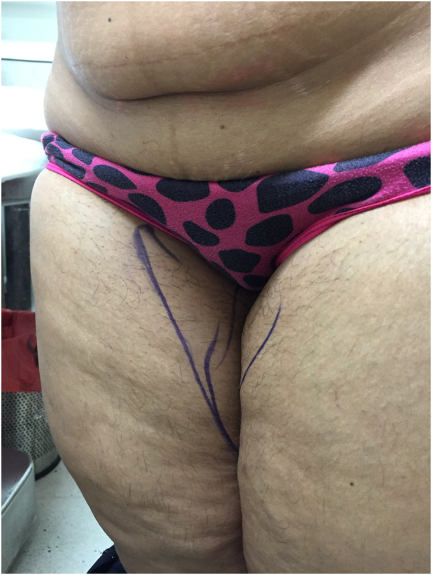 Thigh Fat Removal before